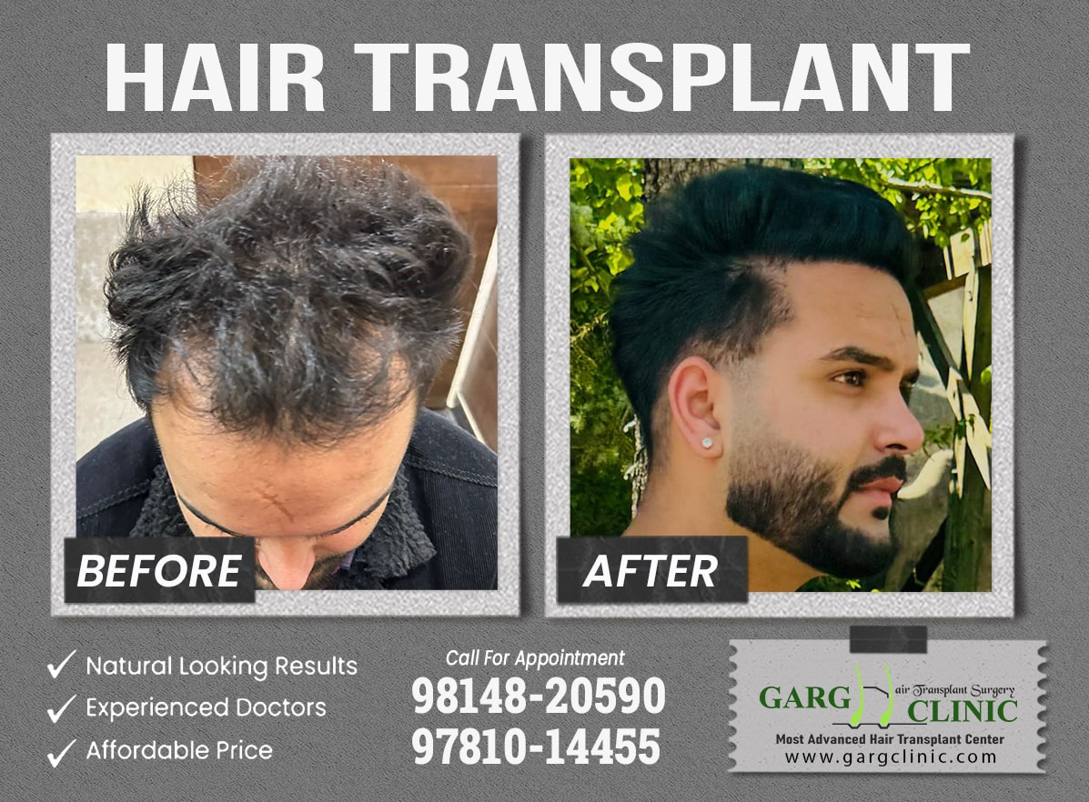 Garg Hair Transplant Clinic