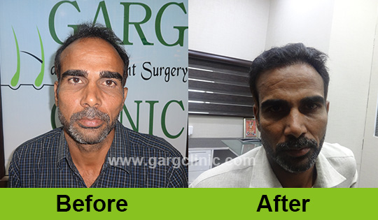 Garg Hair Transplant Clinic