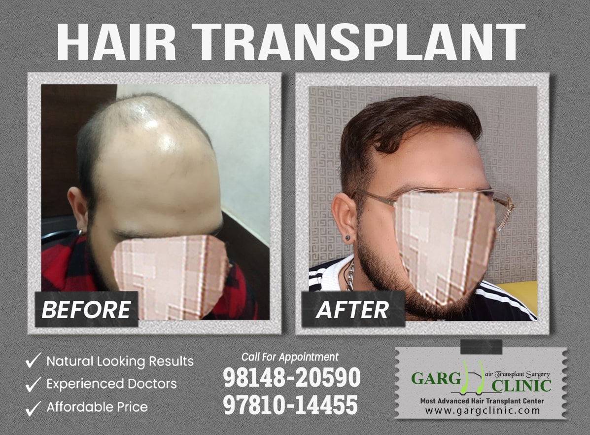 Garg Hair Transplant Clinic