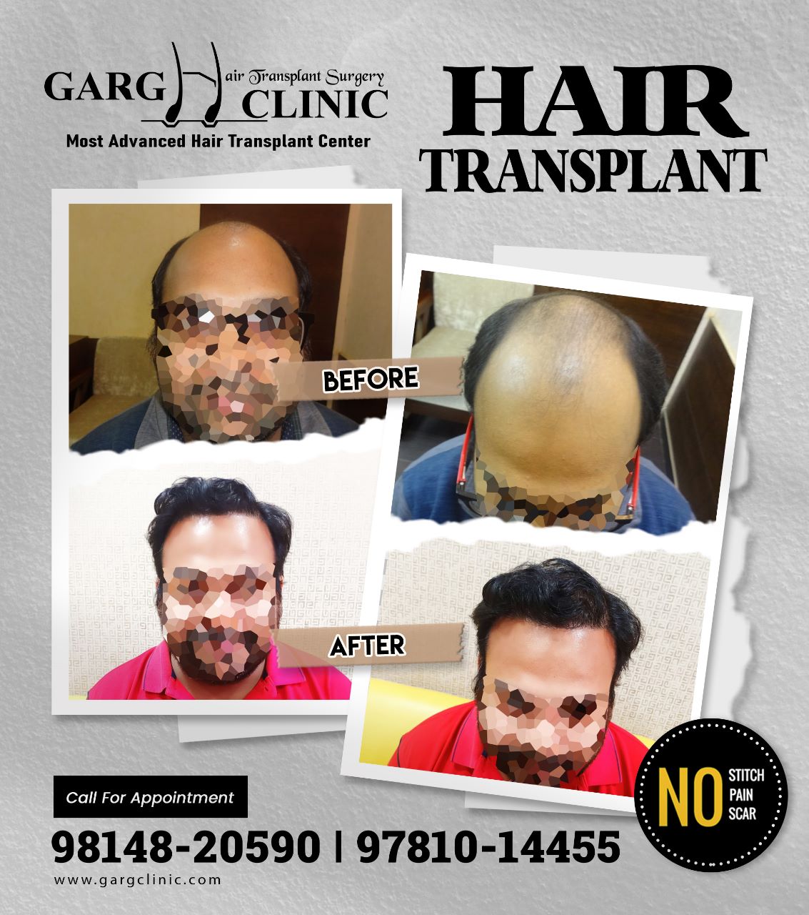 Garg Hair Transplant Clinic