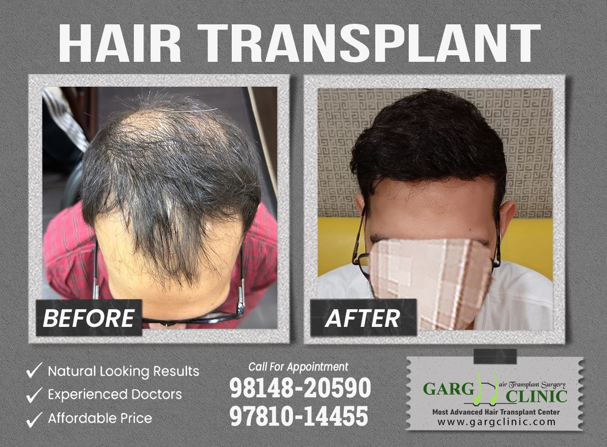 Garg Hair Transplant Clinic