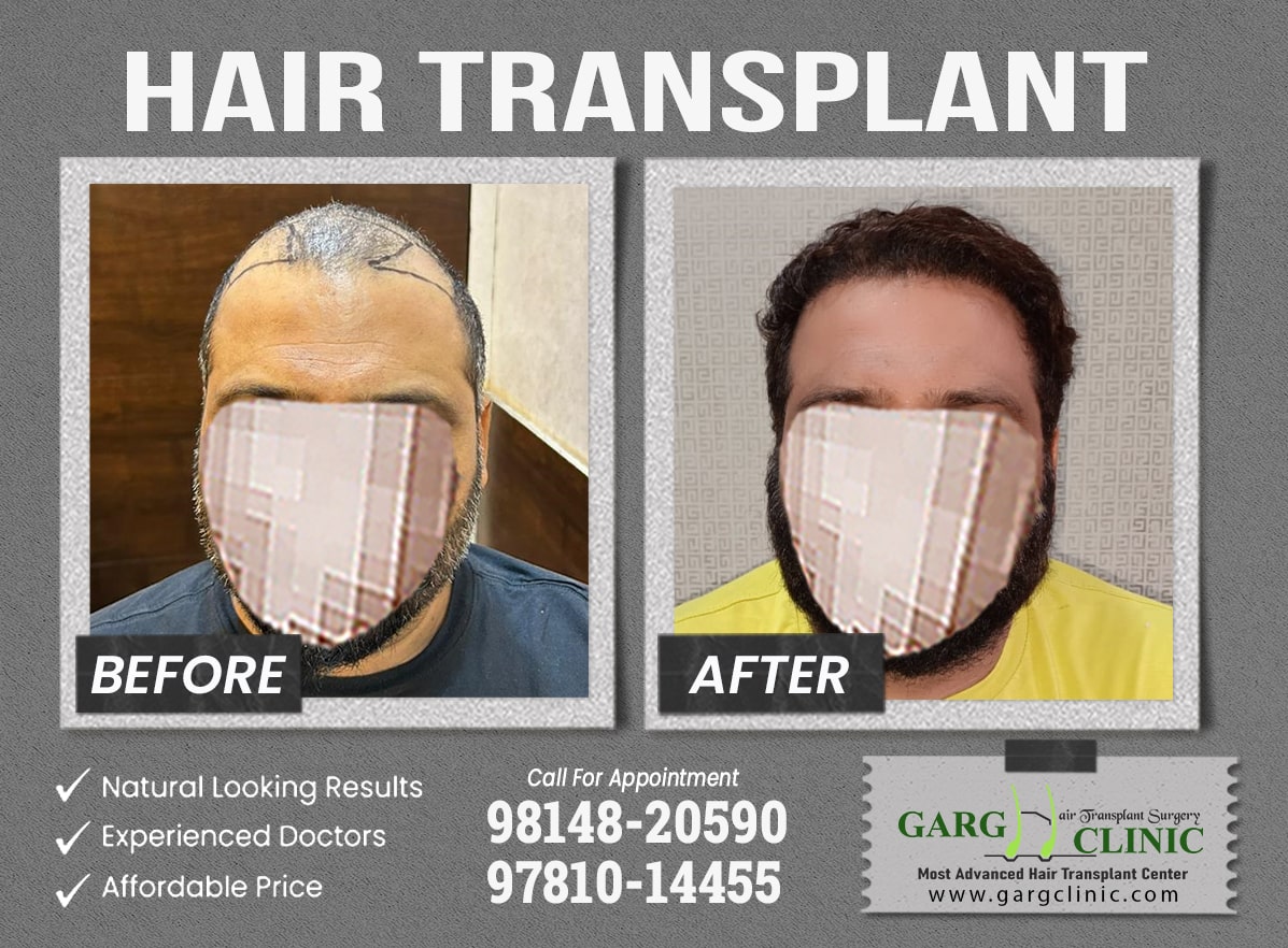 Garg Hair Transplant Clinic